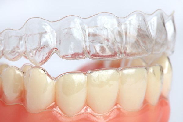 Clear Aligner Teeth Straightening Treatment Overview