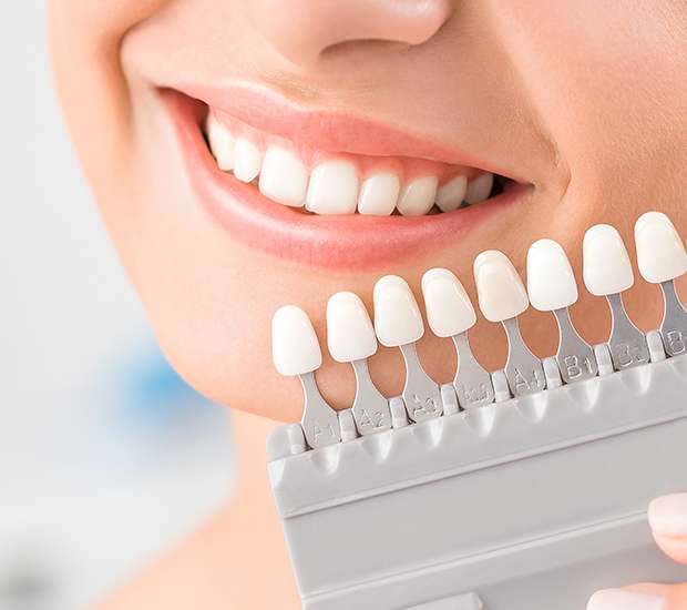 Composite Resin Bonding - Fairfax Cosmetic Dentistry